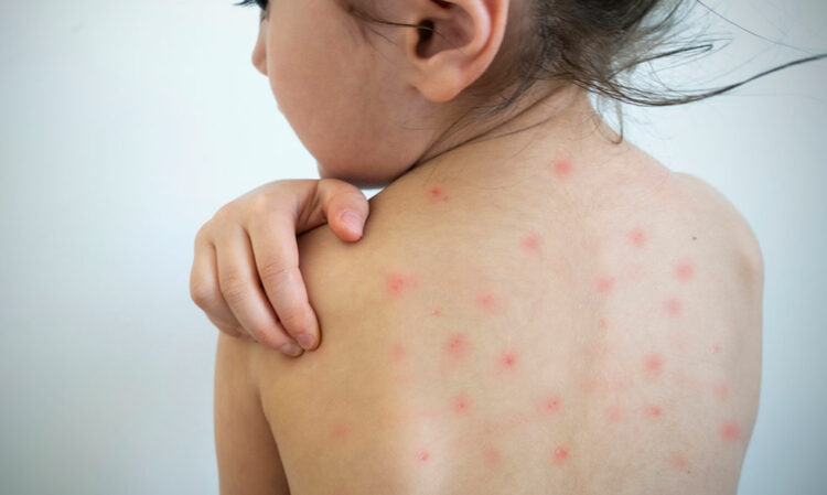 Emite Salud alerta por sarampión importado