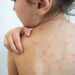 Emite Salud alerta por sarampión importado