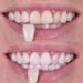 Blanqueamiento dental en Puebla: consigue una sonrisa más blanca con WeDenth