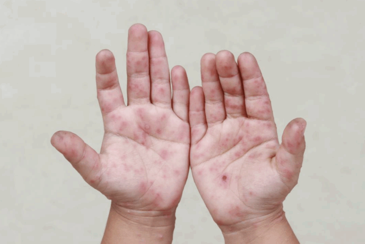 Tamaulipas registra 128 casos del virus Coxsackie. Foto de Web