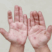 Tamaulipas registra 128 casos del virus Coxsackie. Foto de Web